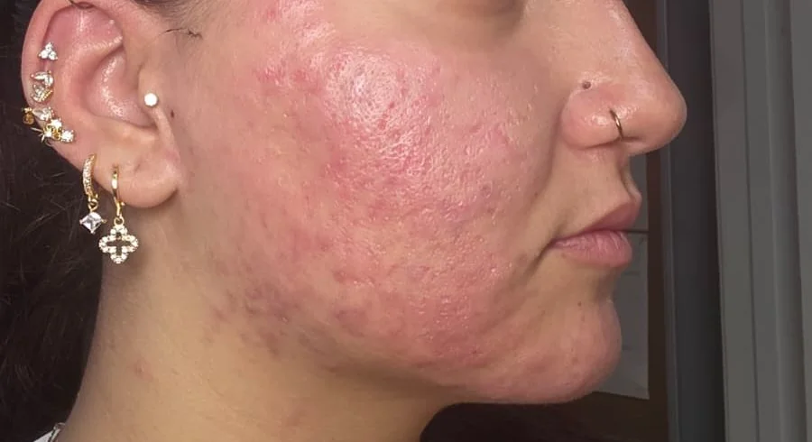 Facial Deep Clean before and after – after