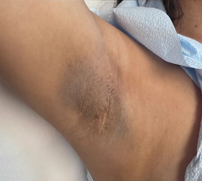 Underarms whitening before and after – before