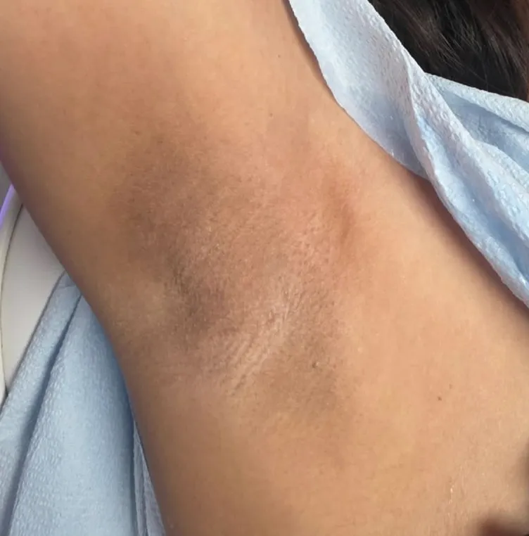 Underarms whitening before and after – after