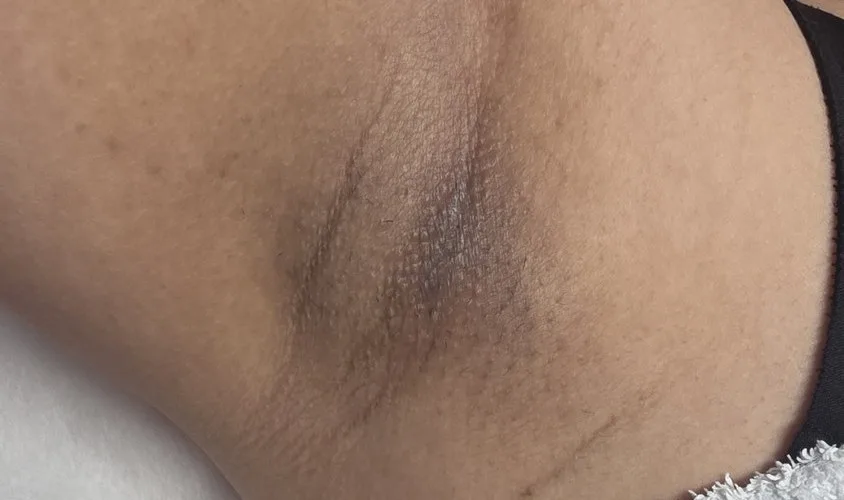 Underarms whitening before and after – before