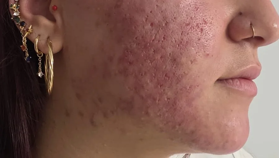 Facial Deep Clean before and after – before