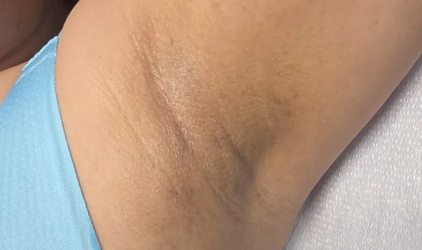 Underarms whitening before and after – after