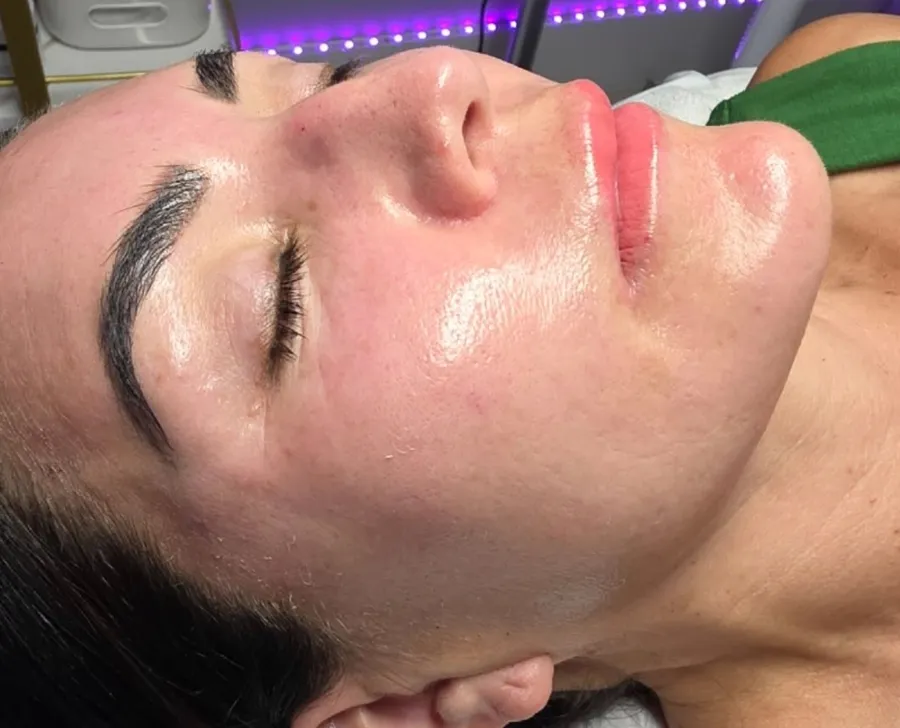 Facial Exosomes Therapy before and after – after