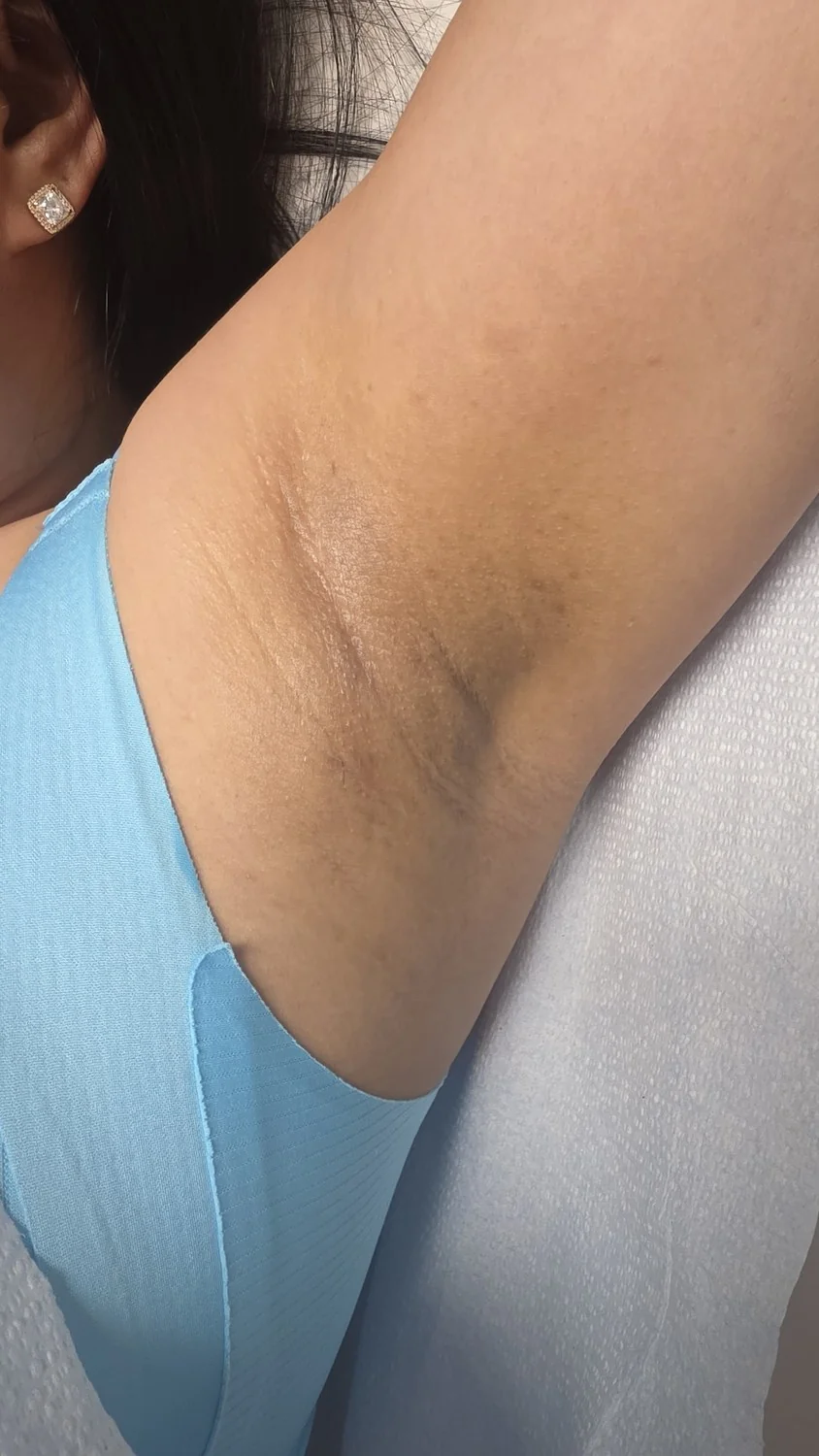 Underarms whitening before and after – after