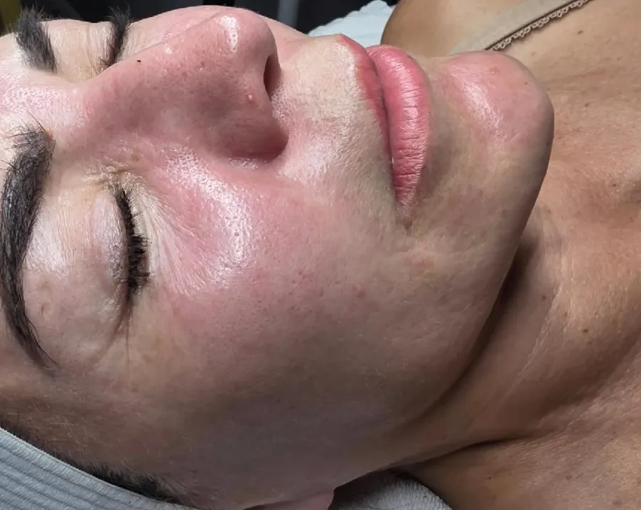 Facial Exosomes Therapy before and after – before