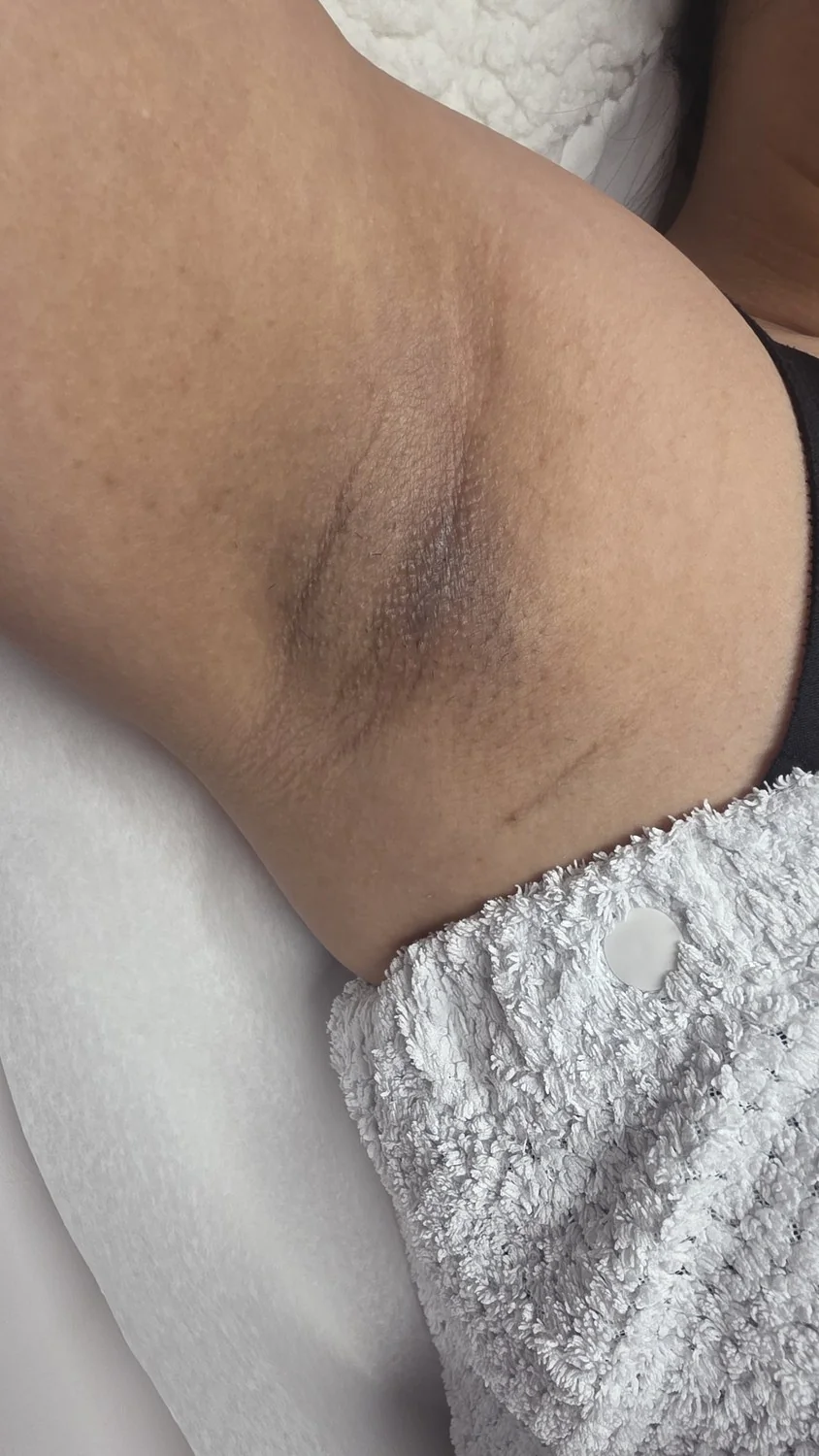 Underarms whitening before and after – before